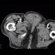 Repair of inguinal hernia, hematoma, mimic of recurrence: CT - Computed tomography